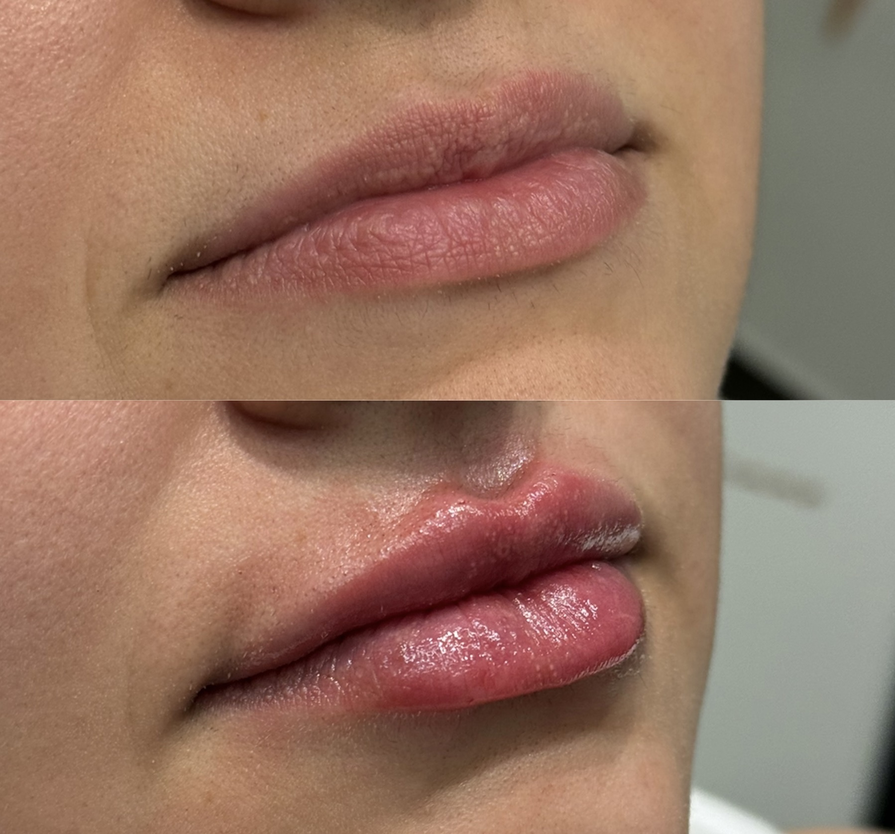 Antes e depois de preenchimento labial