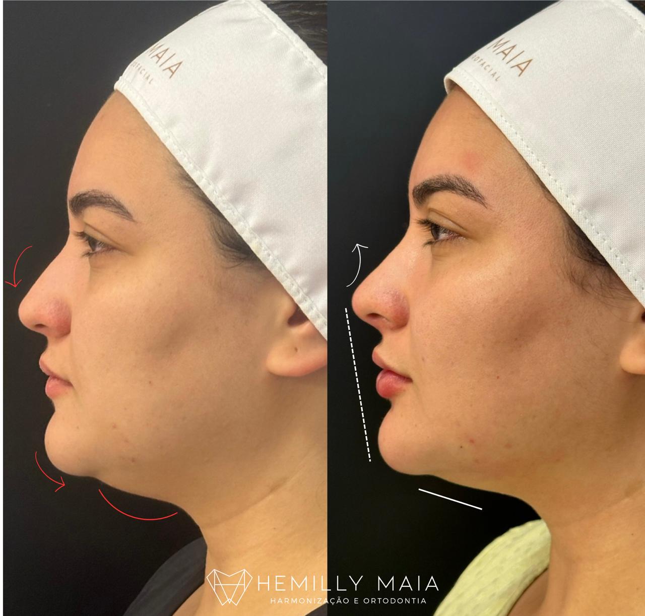 Antes e depois de perfiloplastia e contorno mandibular