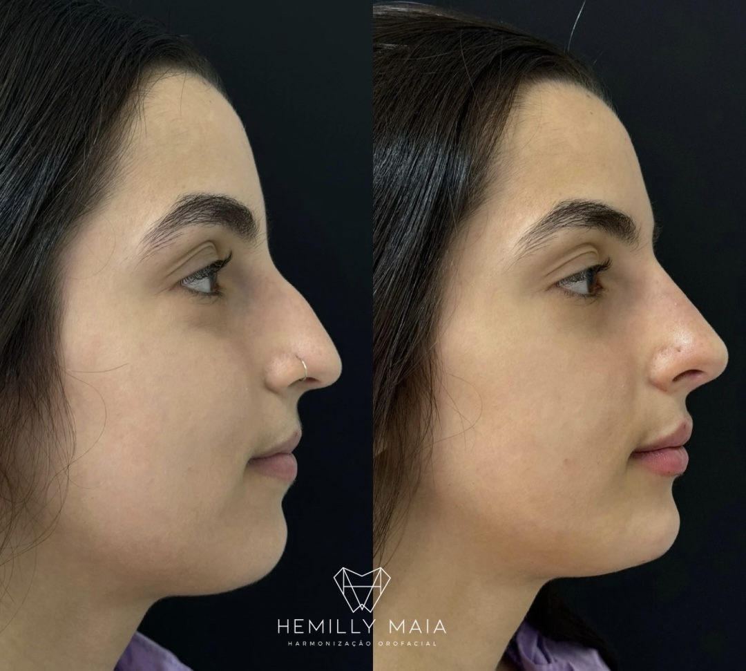 Antes e depois de rinomodelação